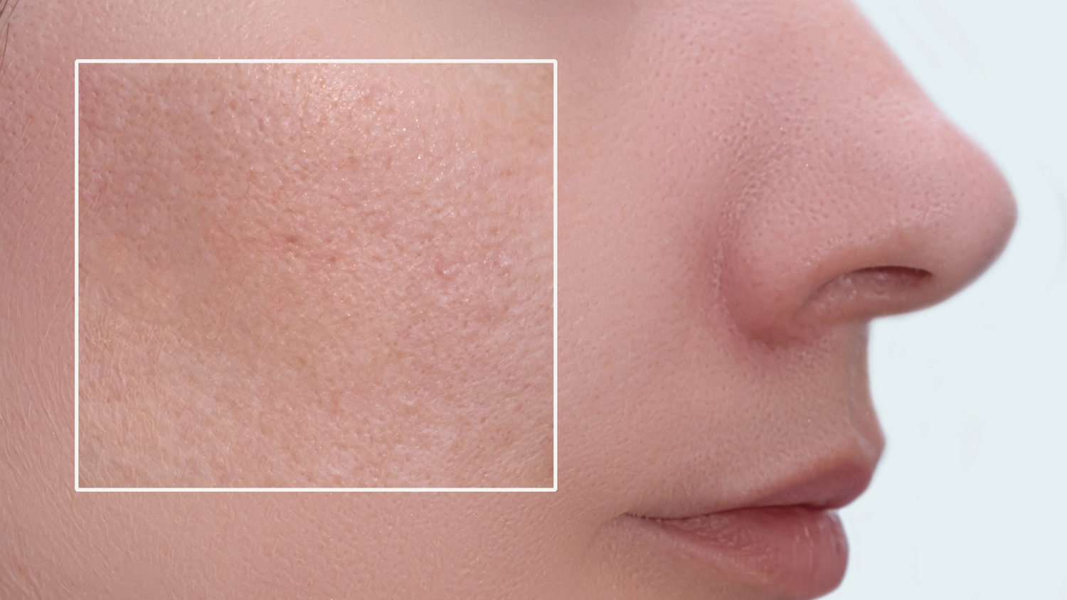 visage de profil d'une femme à la peau blanche avec un zoom sur ses pores dilatés